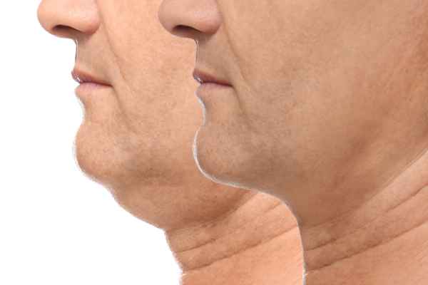 HIFU - Breakthrough in Anti - ageing 2 hifu results Yorkshire