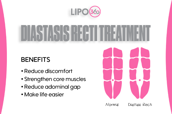Revolutionising Muscle Repair: The Power of LIPO360 Body Sculpt Post-Injury 5 diastasis recti treatment Yorkshire