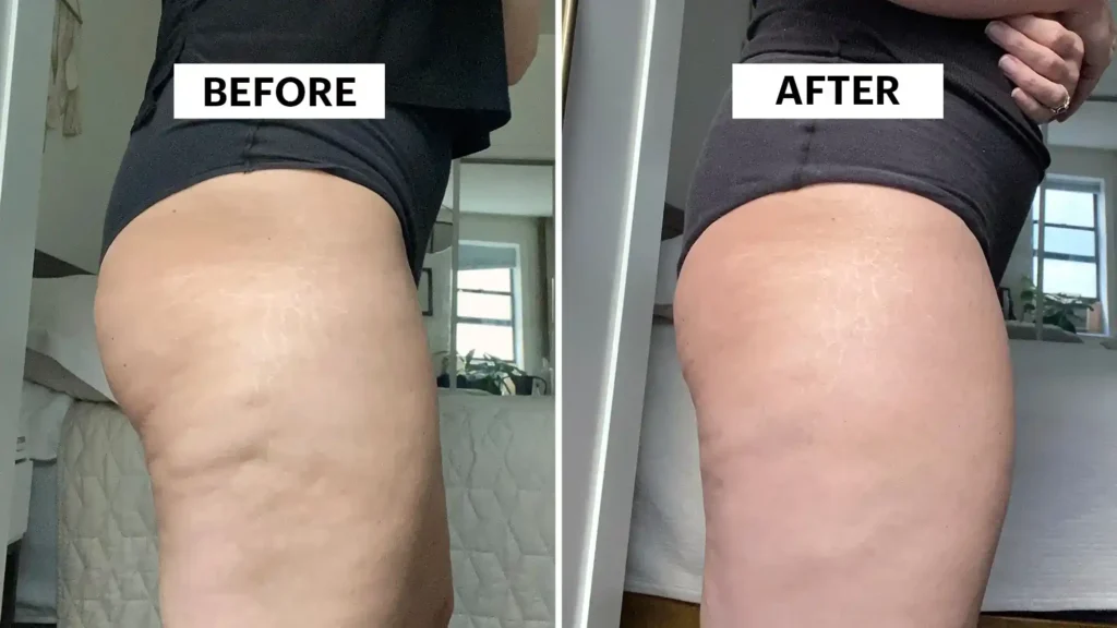 Do Toning Exercise Yorkshire Really Tackle Cellulite?