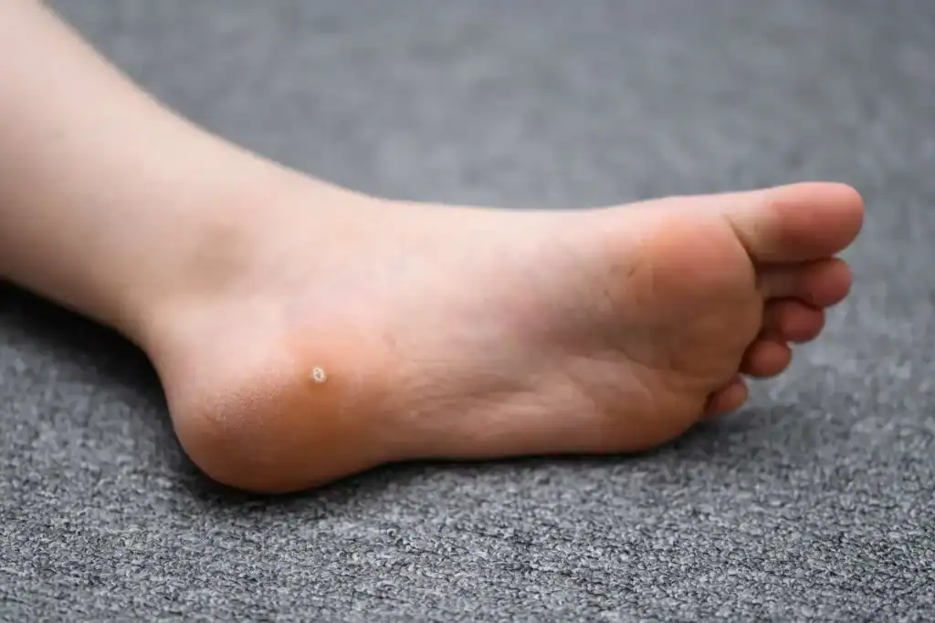 Cryotherapy For Warts And Also Verrucas 2 Image of verruca on the bottom of the foot that able to be treated with Cryotherapy Yorkshire