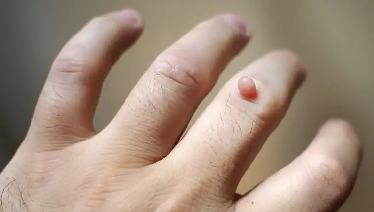 Image of blemish that Cryotherapy Yorkshire can remove with Lipo 360.