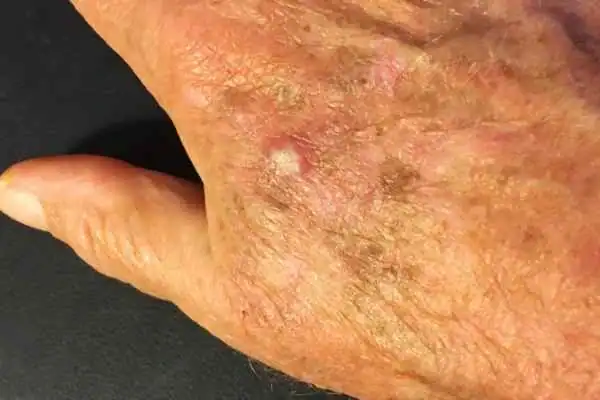 Image of Actinic keratoses Yorkshire on a person hand