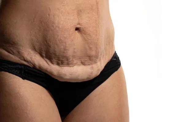 The Science of Skin Tightening 1 The science behind skin tightening Yorkshire picture of a woman's sagging skin on the stomach